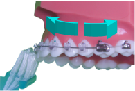 brossage dentaire avec appareil orthodontique-multiattache ou bagues-étape 3