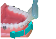 brossage dentaire avec appareil orthodontique-multiattache ou bagues-étape 2