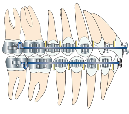 Prognatisme occlusion dentaire latérale après préparation orthodontique et chirurgie orthognatique