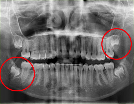 panoramique-dentaire-indication-extraction-dents-de-sagesse