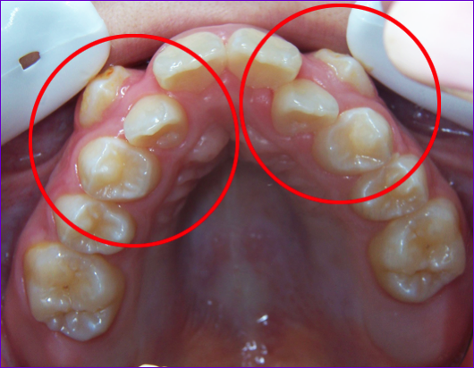 Fort-encombrement-dentaire-maxillaire-justifiant-des-extractions-de-premolaires
