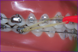 Orthodontie-multiattache-multibagues-mettre-les-elastiques-intermaxillaires-etape3