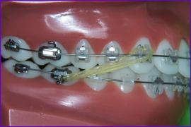 Orthodontie-multiattache-multibagues-mettre-les-elastiques-intermaxillaires-etape4